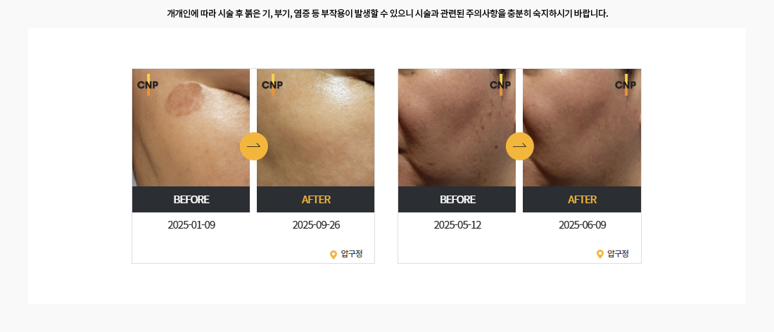 어븀야그 레이저 시술 전후 사진