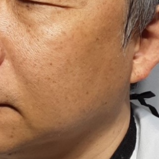 시술전  이미지 
