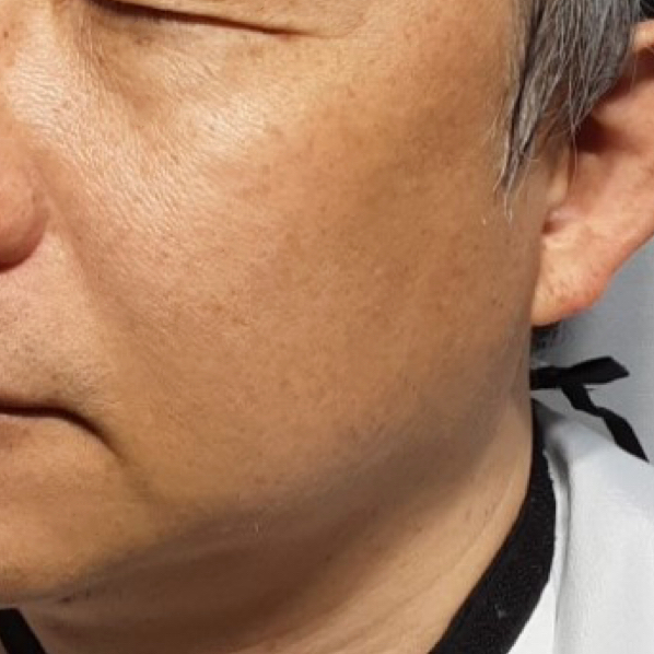 시술후   이미지