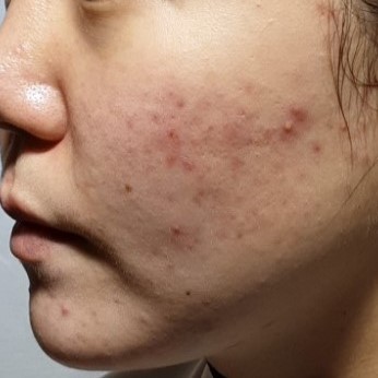 시술전  이미지 