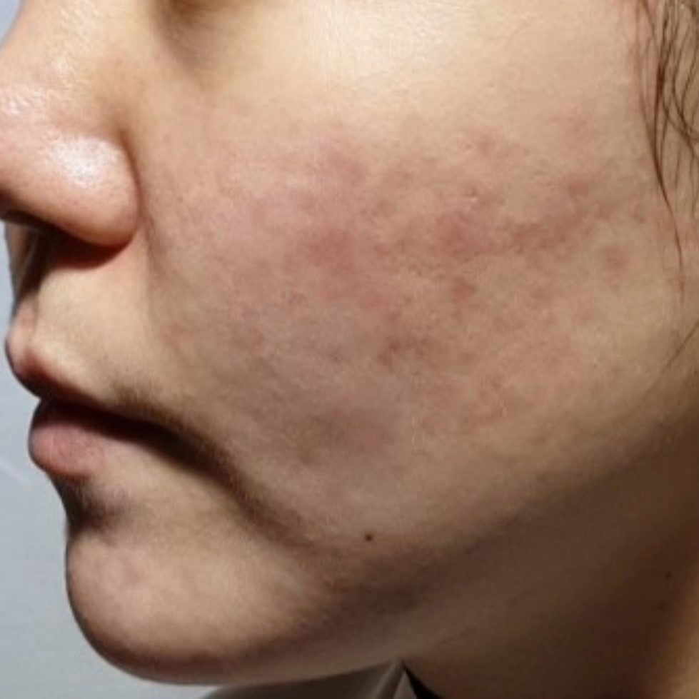 시술후   이미지