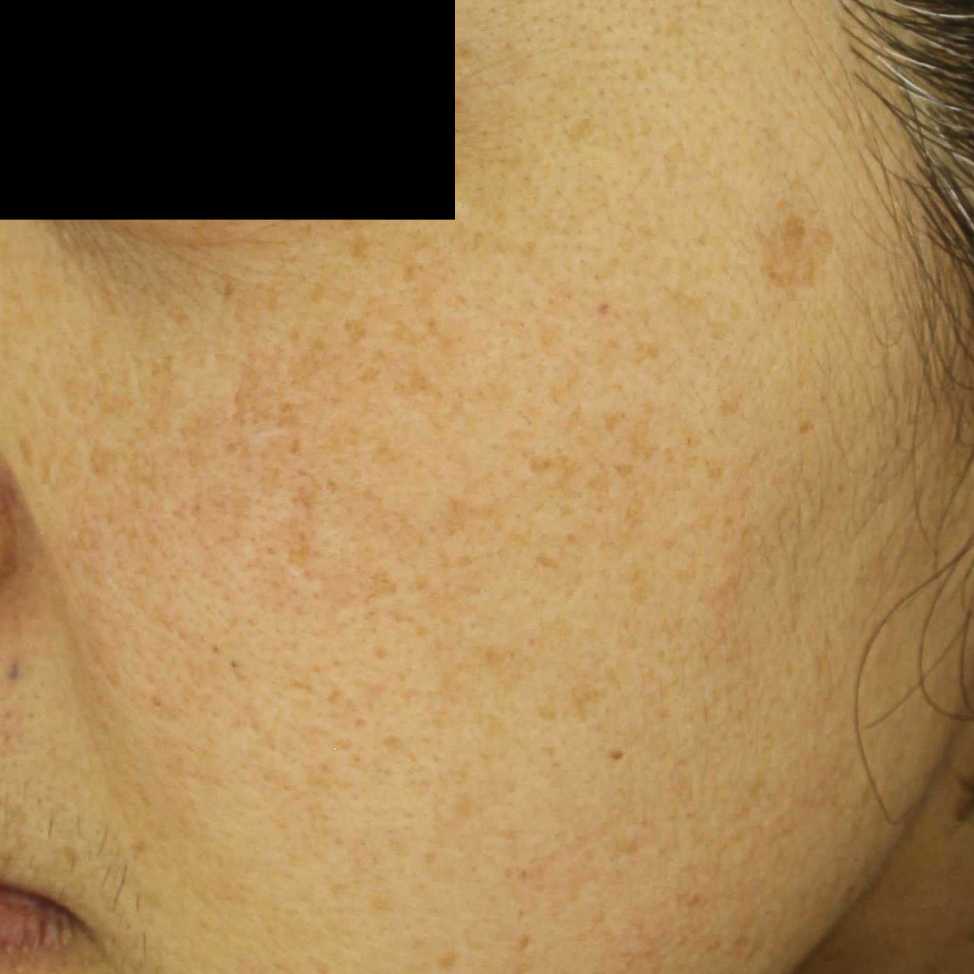 시술전  이미지 