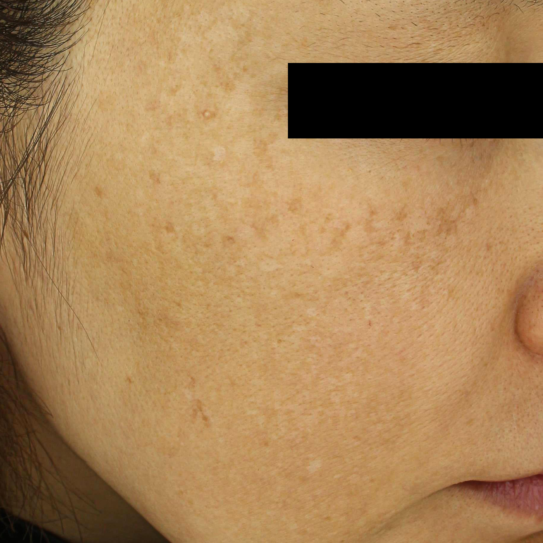 시술전  이미지 