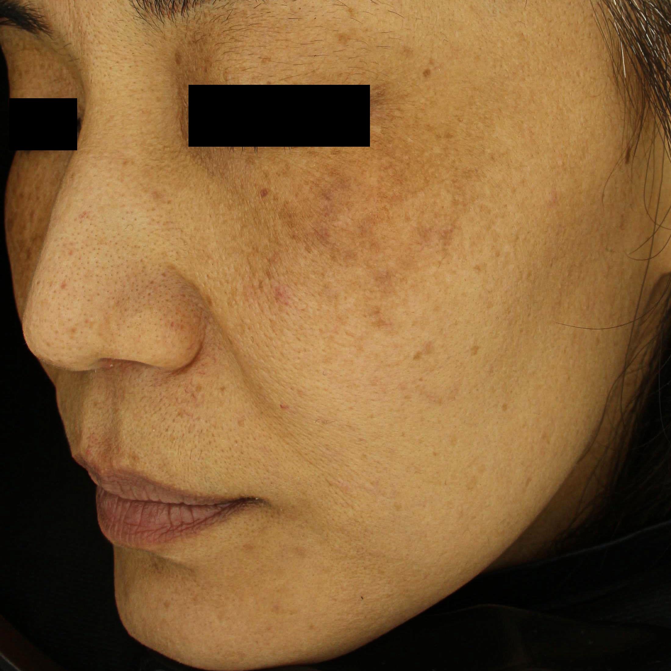 시술전  이미지 