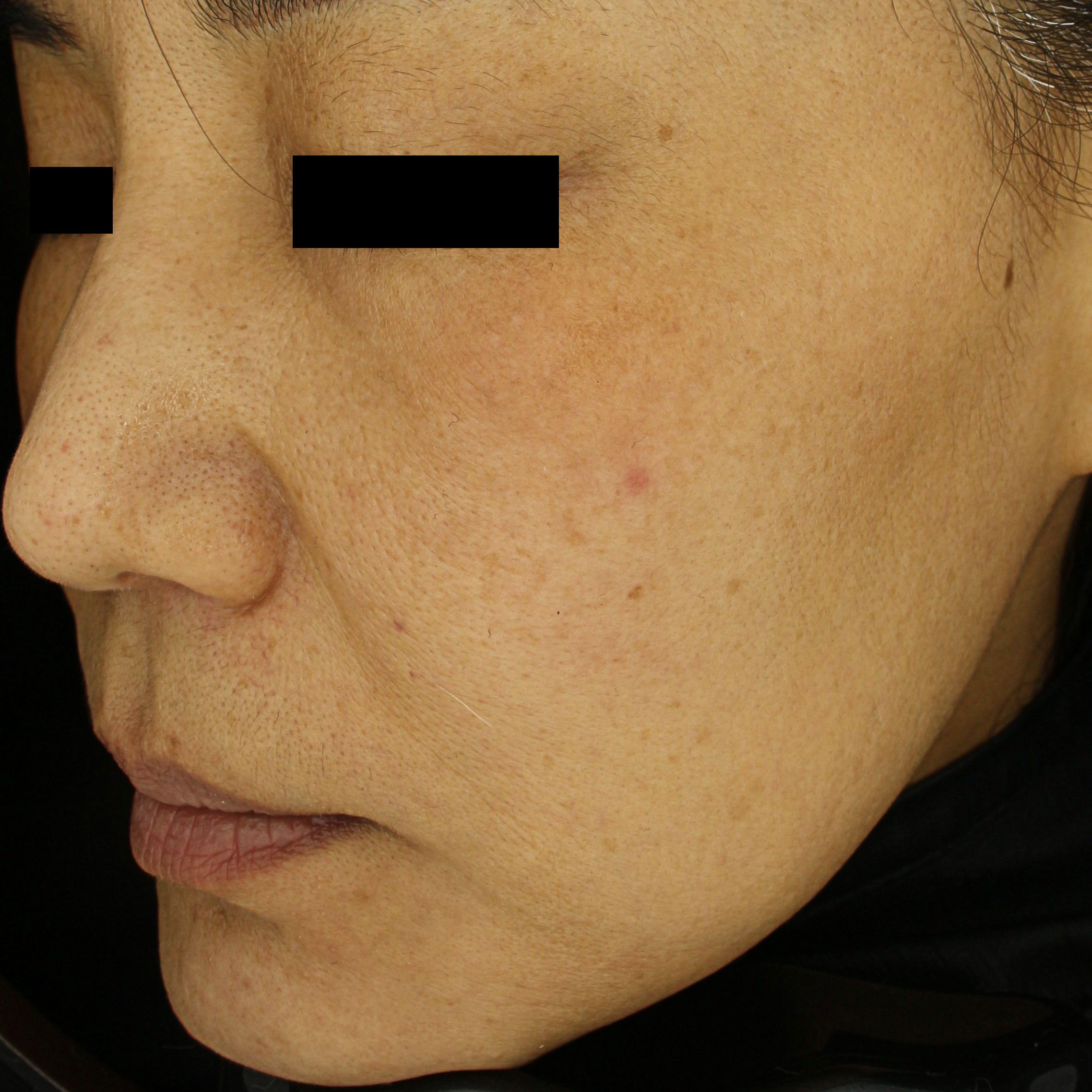 시술후   이미지