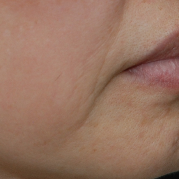 시술전  이미지 