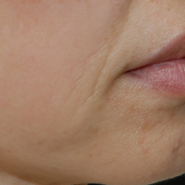 시술후   이미지