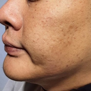 시술전  이미지 